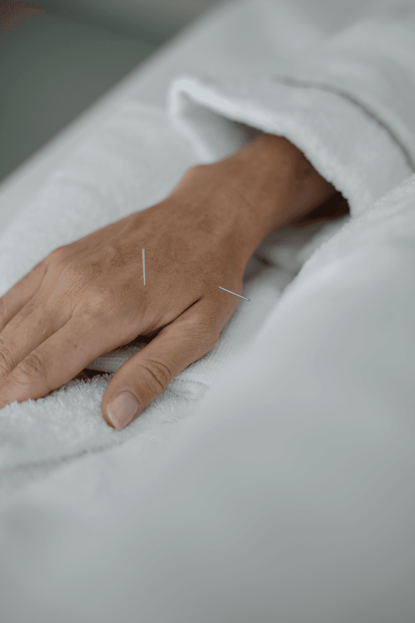 Acupuncture